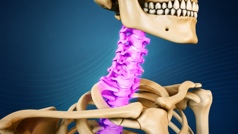 Neck Fusion Surgery Explained: What to Really Expect Before, During and After
